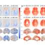 AI-enabled measurements of 'local brain aging' offer detailed insights on dementia and more