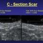 Study reports significant reduction in postsurgical scar depth following DC microcurrent stimulation