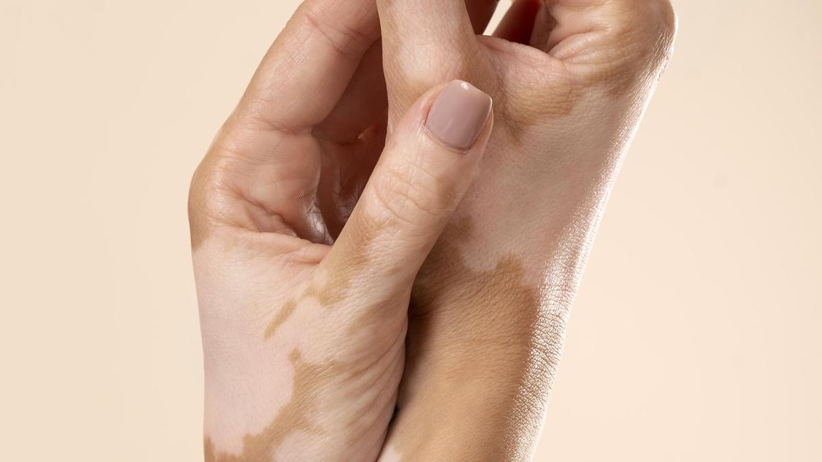Understanding vitiligo