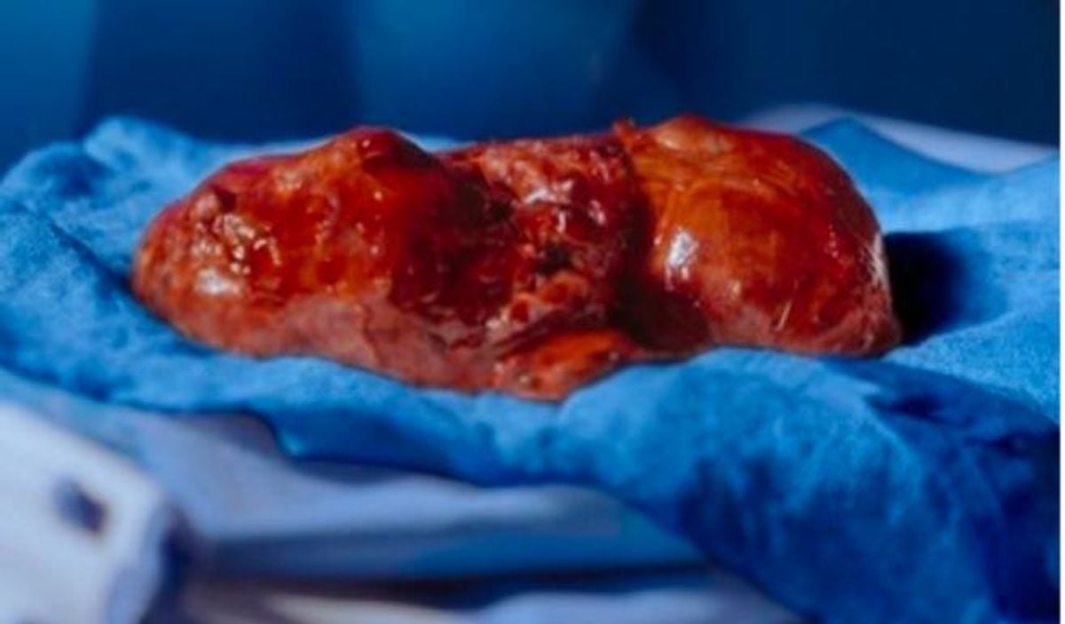 Dr. Khalid Al-Ruhaimi Hospital removes complex 2.5 kg thyroid tumor