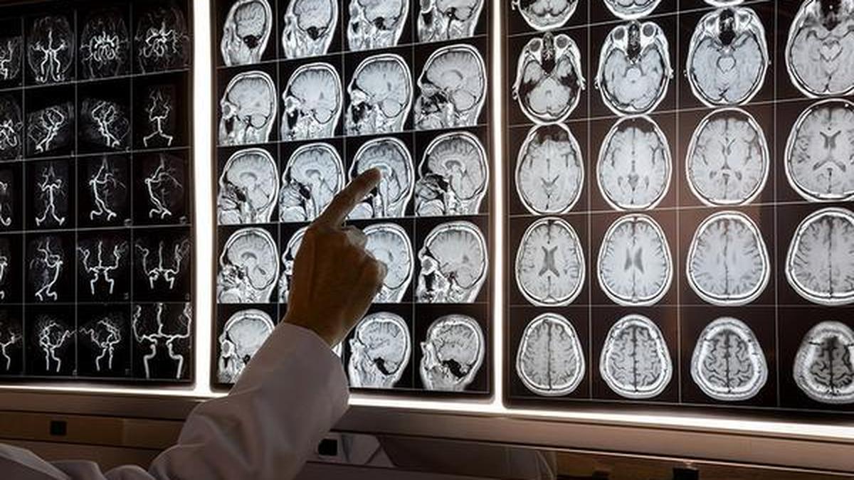 What is brain fog and when does it needs investigation
