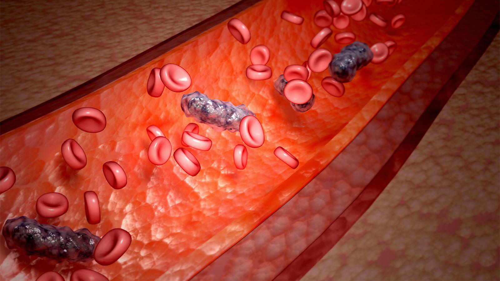 Sepsis in Pregnancy Is a Deadly Combo: Here's Who's at Risk