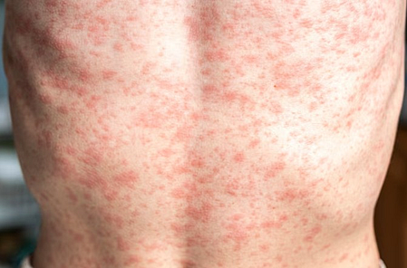 Fifth measles-associated death reported in US