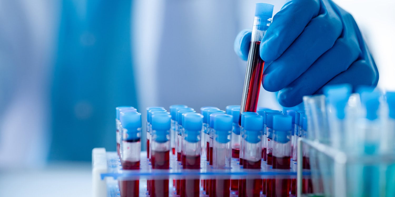 New blood tests accurately detect Alzheimer’s disease in adults with Down syndrome