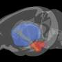 Research reveals a specific brain circuit implicated in OCD