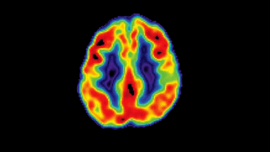 For years dementia researchers had no answers, but now the word ‘breakthrough’ is on their lips