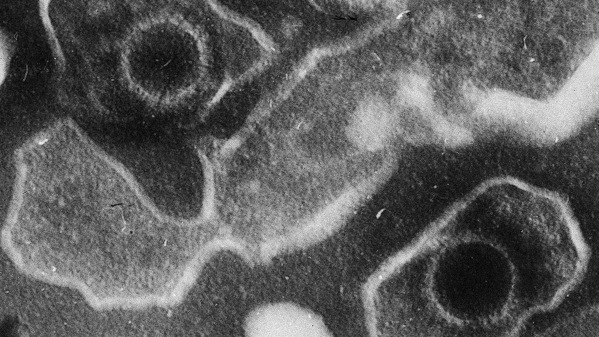All you need to know about: Epstein-Barr virus