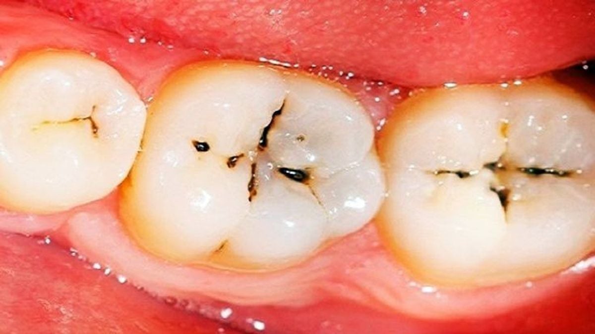 Study links mental health to oral and dental wellbeing