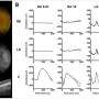 Unexpected link identified between rare metabolic disease gene and inherited blindness