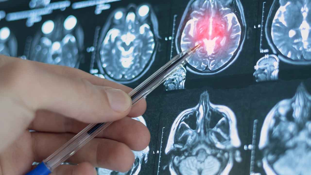 Chinese brain-reading AI model may help predict depression risk 4 years in advance
