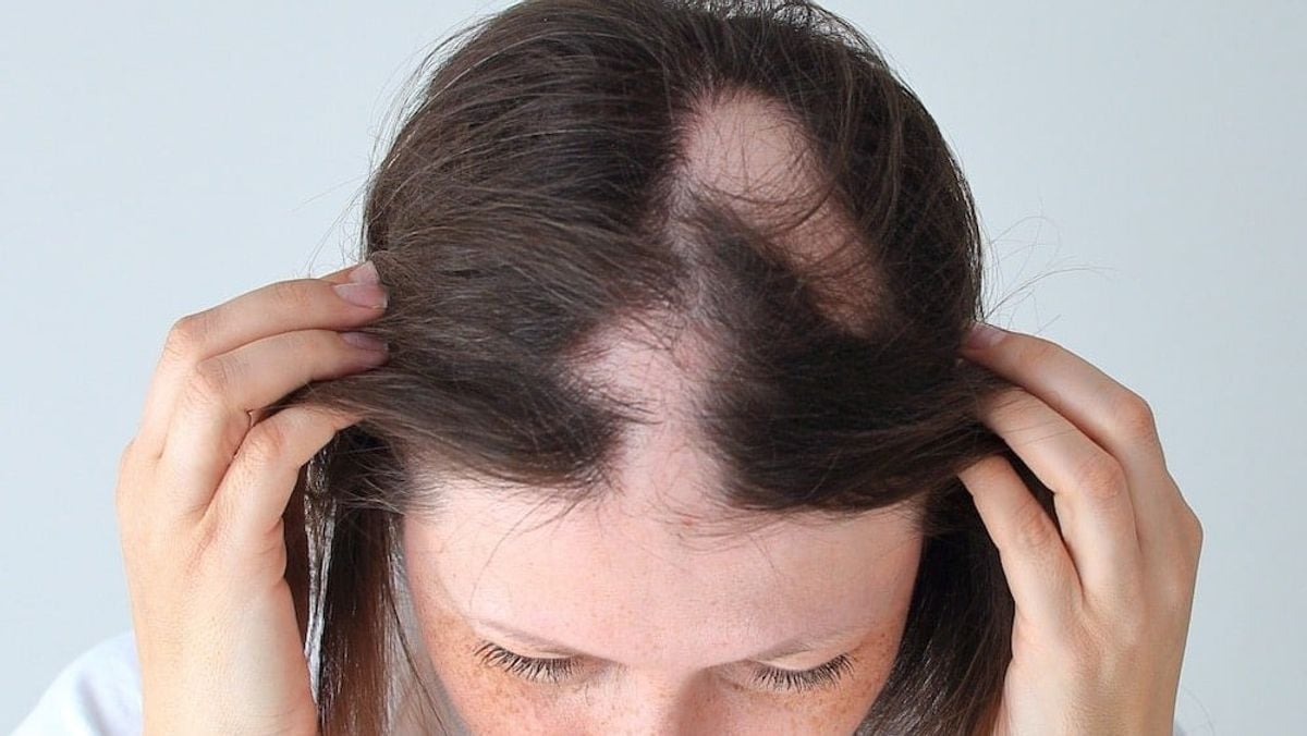 US study finds immune drug effective for alopecia areata hair regrowth