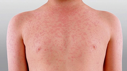 Study warns of measles risk with 1.7 million Australians vulnerable
