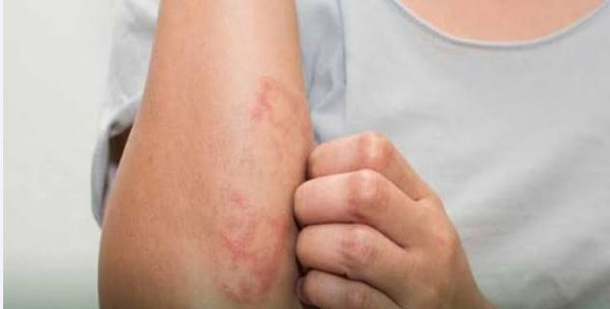 Unexpected causes behind skin abscesses unrelated to hygiene