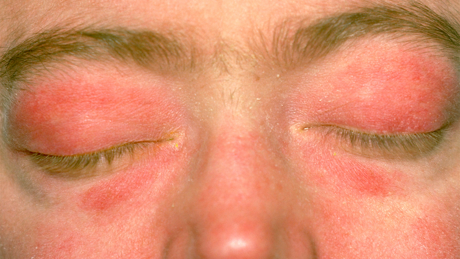 Treatment Landscape for Dermatomyositis Is Evolving