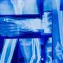 Biochemists discover new strategy to combat pediatric bone cancer
