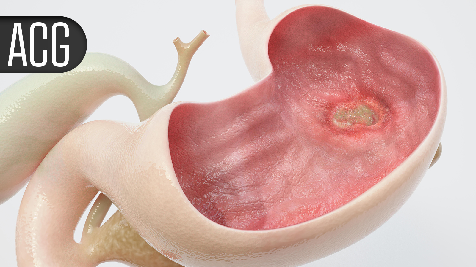 Enzyme Supplement May Ease IBS Symptom Severity