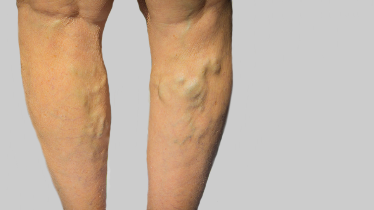 Have varicose veins? 3 simple tips to follow before playing Garba this Navratri