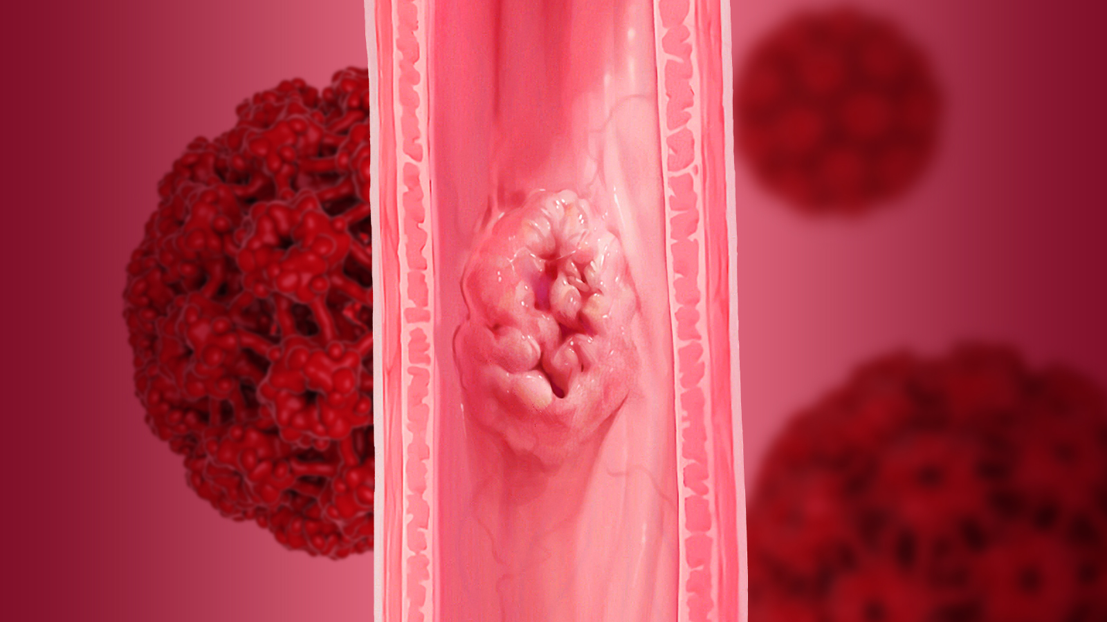 HPV Infection and Esophageal Cancer