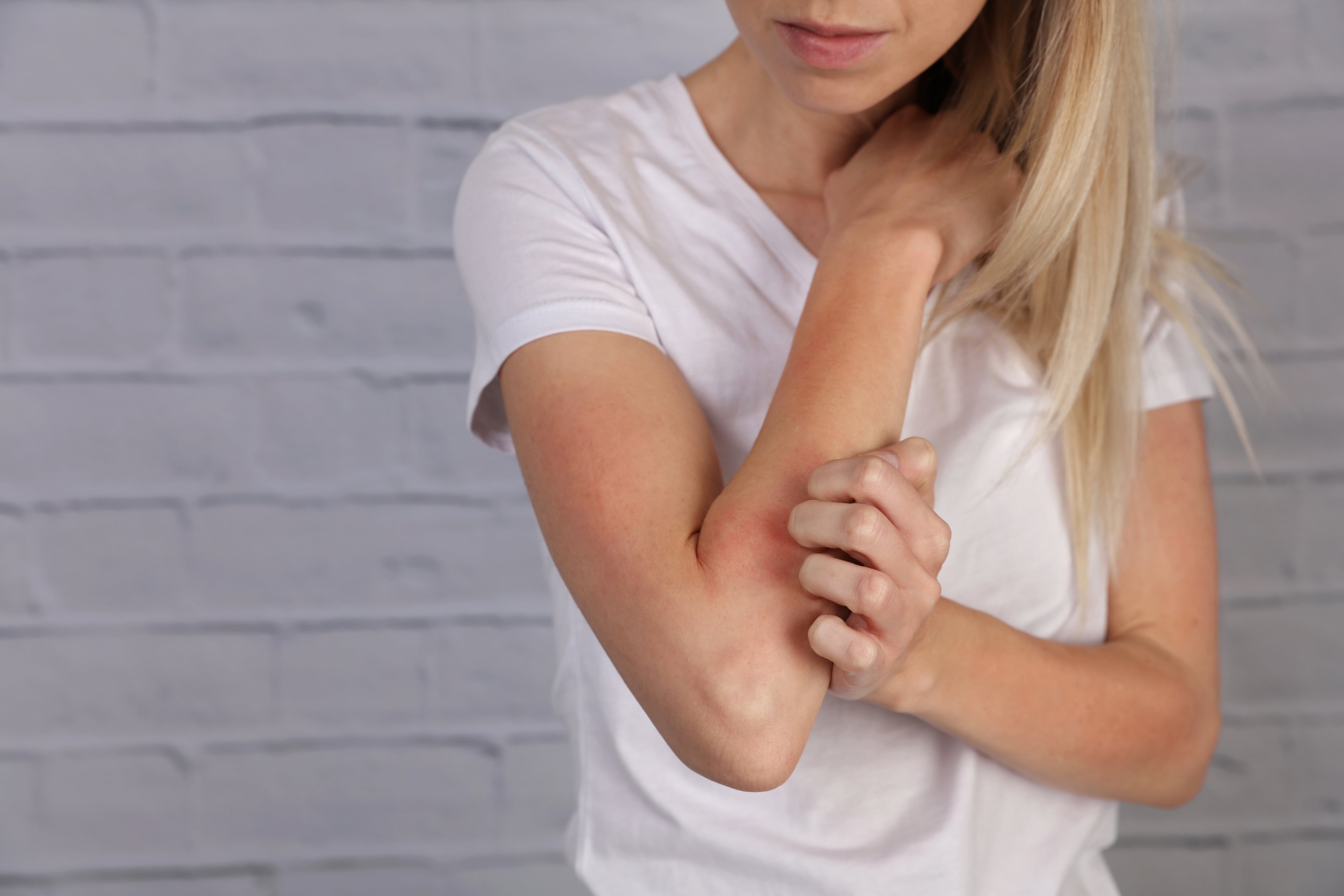 Scratch that itch: Why focusing on inflammation can reduce symptoms