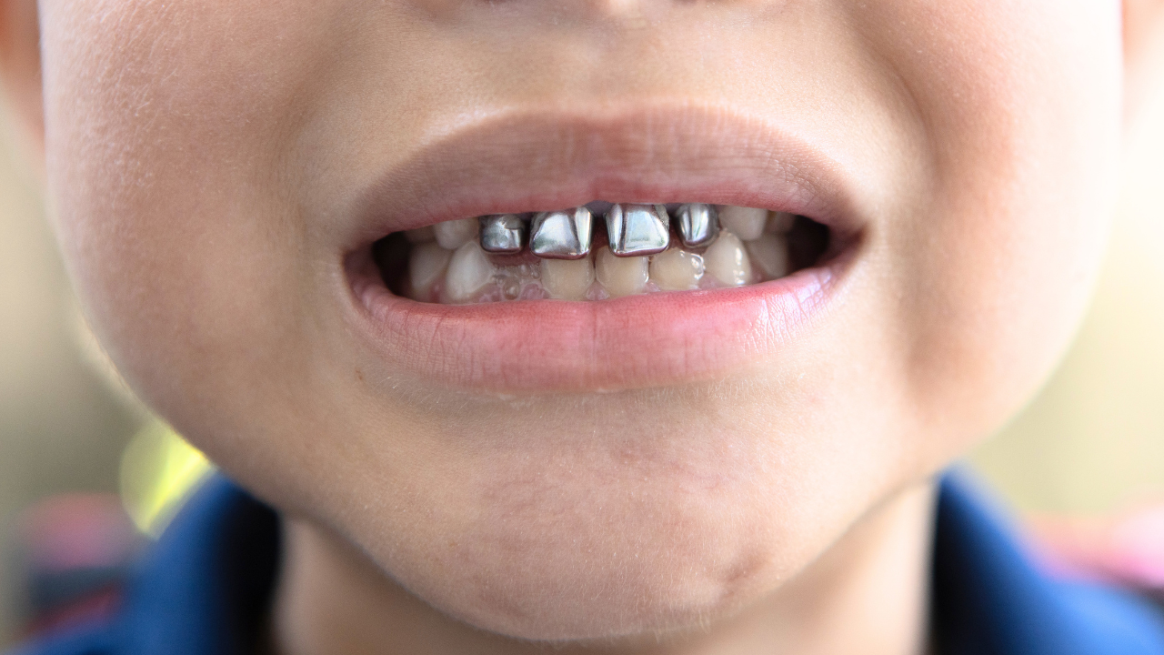 Who are ‘silver tooth kids’ and why is the internet calling them ‘bad’?
