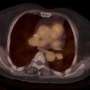 Molecular imaging demonstrates promise for predicting complete pathologic response in HER2-positive breast cancer