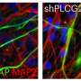 Rare gene variants may multiply Alzheimer's disease risk