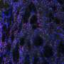 Huntington's disease discovery opens door to a new class of treatments