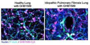 Rewriting Disease: Oligonucleotides Take Aim at the Untreatable