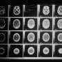 Laser therapy offers weapon against deadly brain tumors
