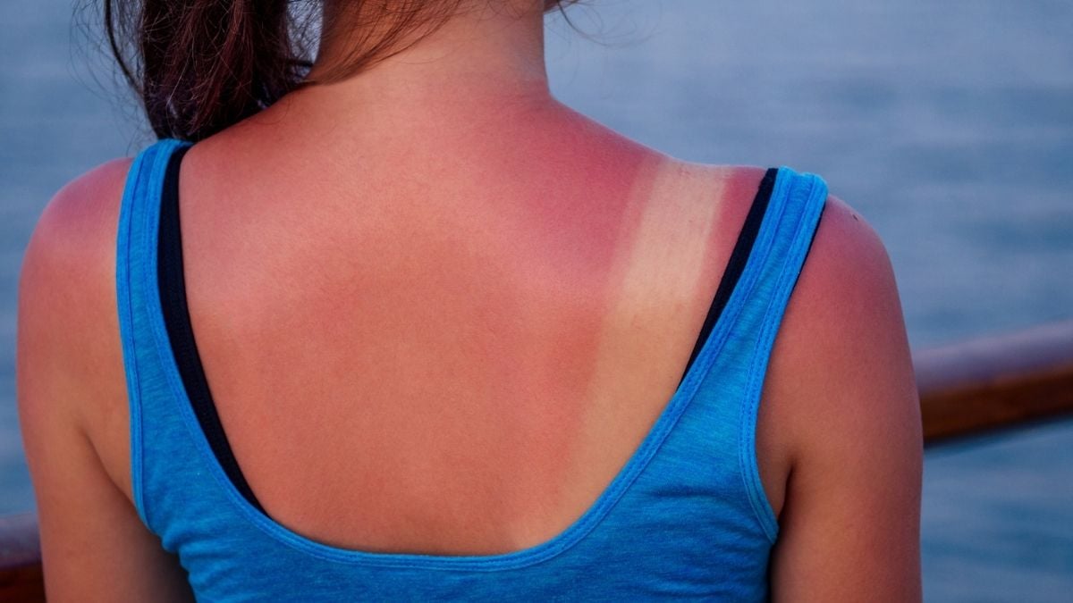 Bad News: Just One Intense Sunburn Really Can Be 'Life-Changing'