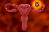 Ectopic Pregnancies Can Rupture a Fallopian Tube and Become Life-Threatening, but Cases Are Relatively Rare
