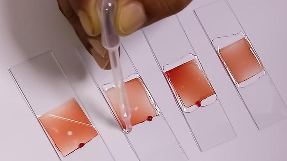 IIT Bombay develops low-cost device to screen for anaemia, sickle cell disease