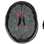 Neural network spots previously missed epilepsy signs on brain MRIs