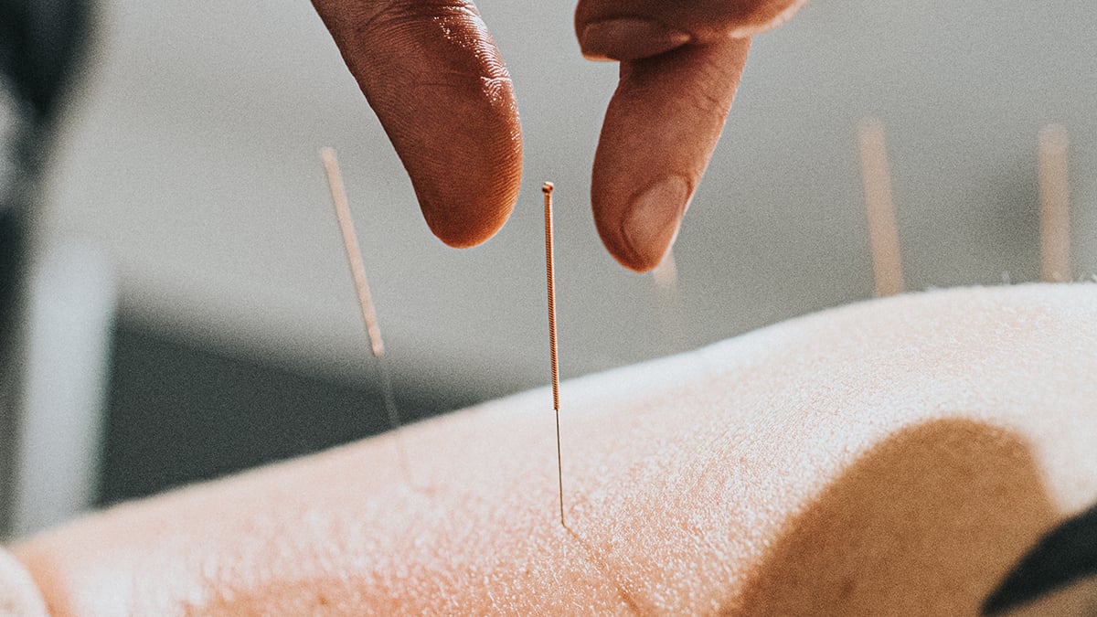 Acupuncture Seems to Rewire The Brain in Depression, Scans Reveal