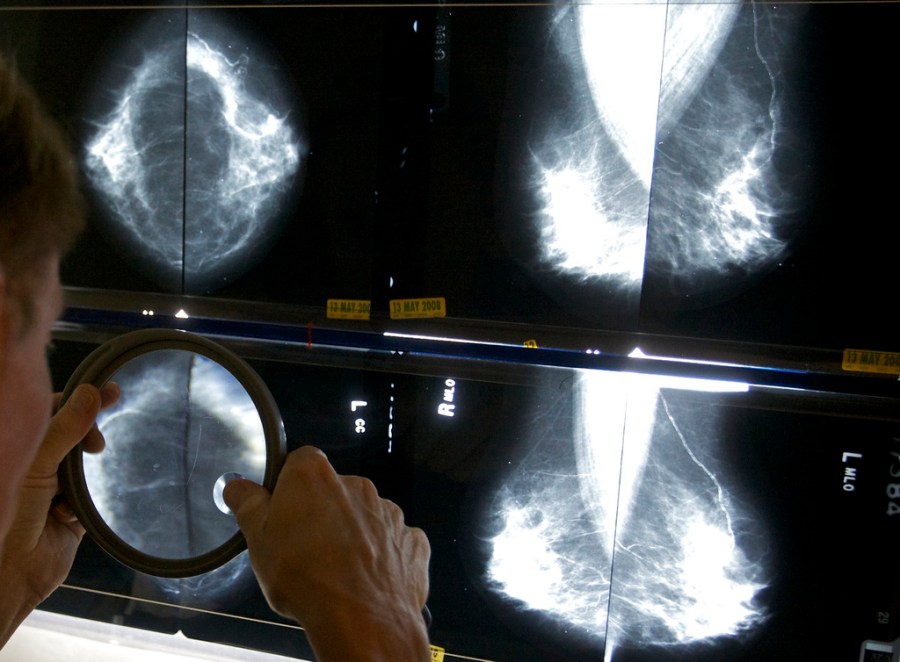 Breast cancer prevention starts with knowing your risk