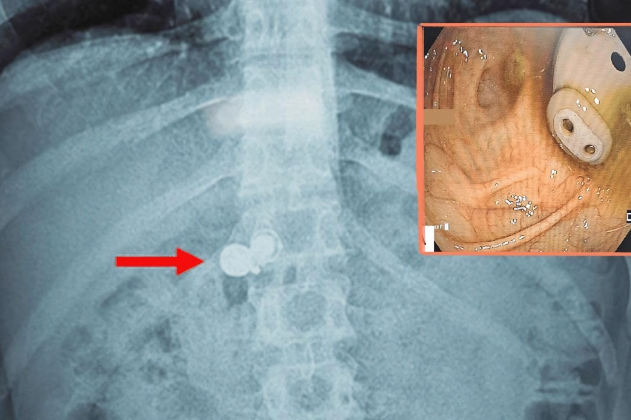 Man swallows earbud in his sleep, hears it beeping from his stomach
