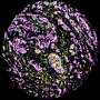 AI reveals distinct cell defects inside breast cancer