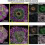 Patchy brain development may help explain autism's varied traits