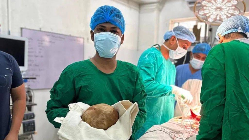 Doctors in Sri Lanka remove 3.1kg stone from man’s bladder and claim record