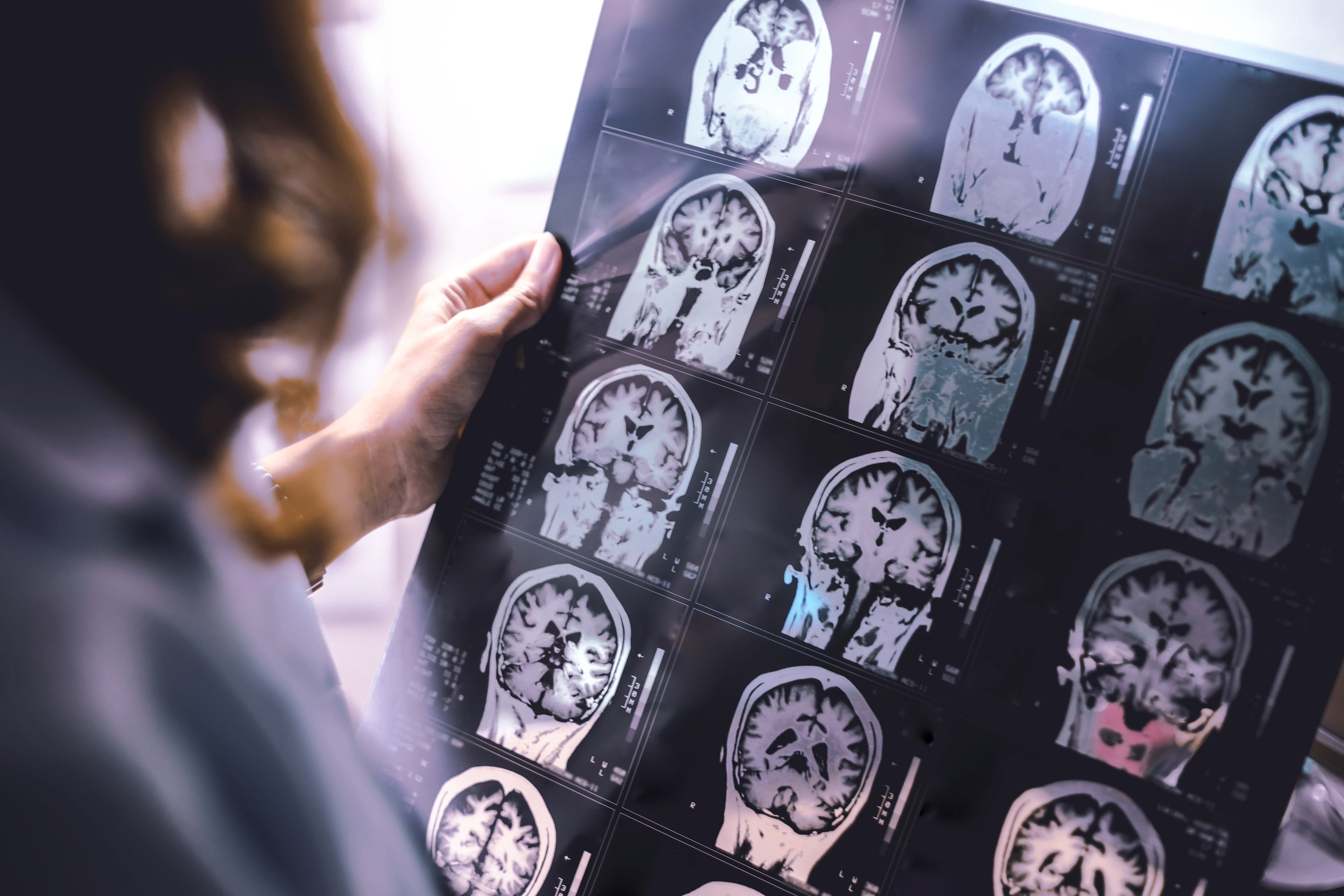 Scientists identify three things to avoid in middle age to stave off dementia