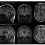 AI-calculated brain age predicts dementia risk years before doctors can see it