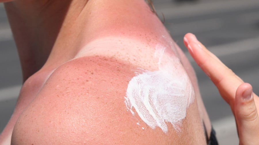 Warning of sunburn: "Tanmaxxing" trend: Experts warn of sunburn