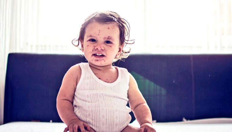 Can a new drug help fight measles?
