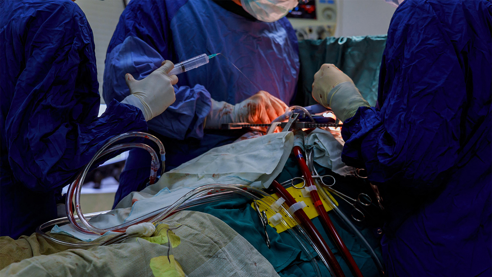 Dapagliflozin Makes Good on Preventing Cardiac Surgery-Associated AKI