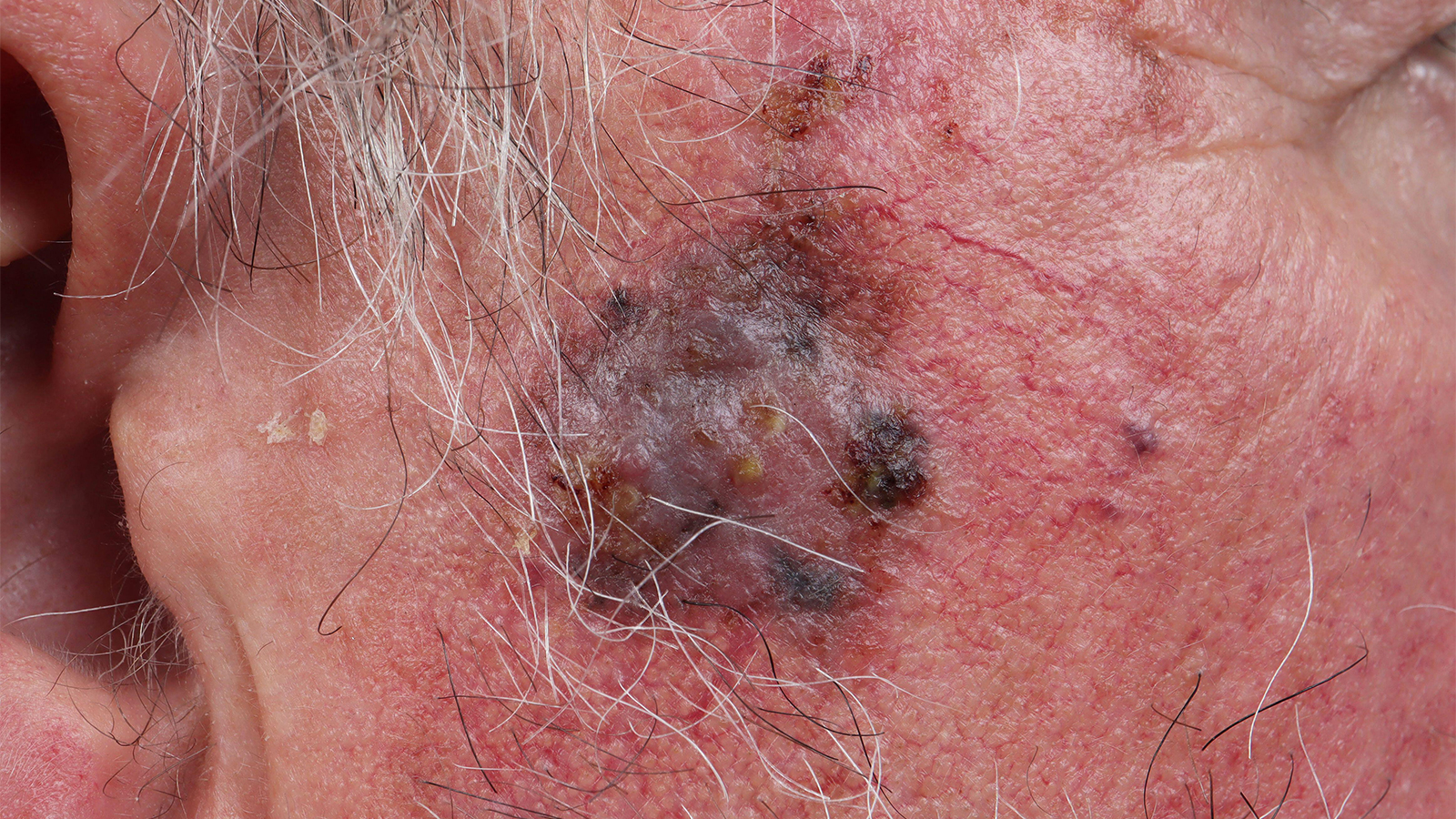 Twice-Rejected Melanoma Drug Gets Love From FDA Panel