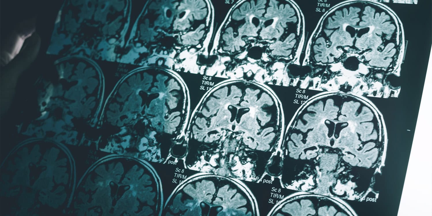 Brain wiring patterns linked to harm avoidance in obsessive-compulsive disorder