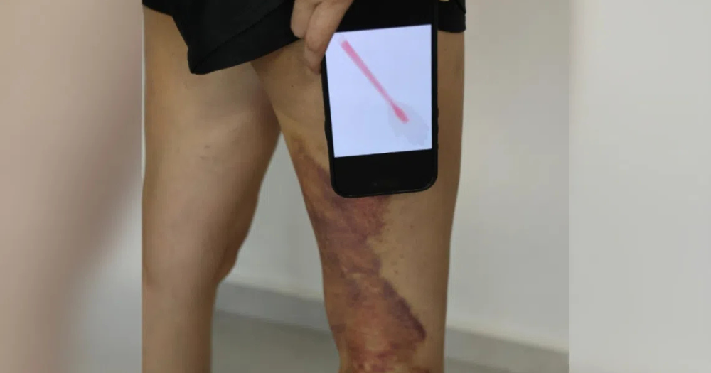 S'pore woman gets dark purple bruising from wooden board treatment, wellness centre apologises & offers free treatment