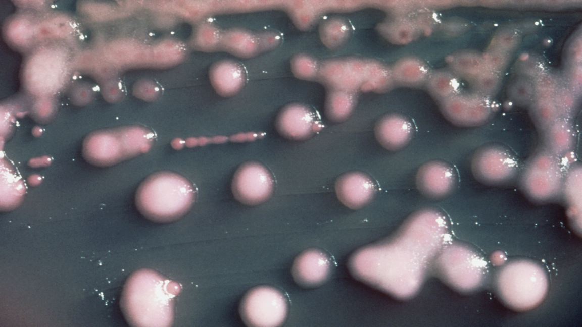 A woman got a UTI. Two years later, the bacteria had evolved, invaded her brain.