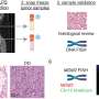 Protein 'switch' determines whether liposarcoma cells will become aggressive