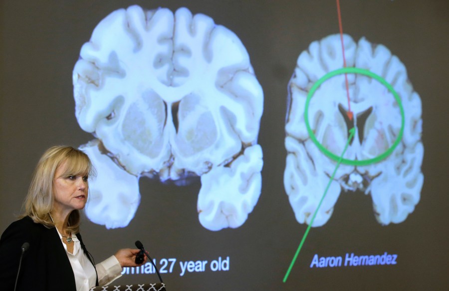 1 in 4 NFL players suffer from brain disease. Where is the accountability?